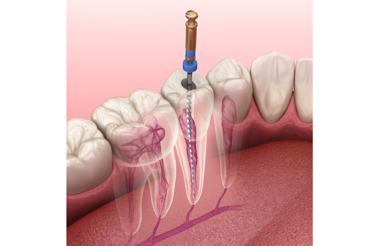 Wurzelbehandlung / Endodontie